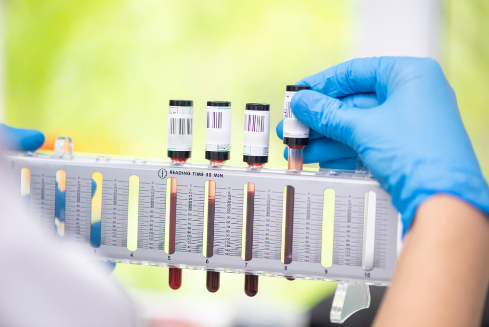 sedimantasyon-hizi-esr-nedir_20201116092210